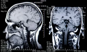 Magnetic resonance imaging types abnormalities